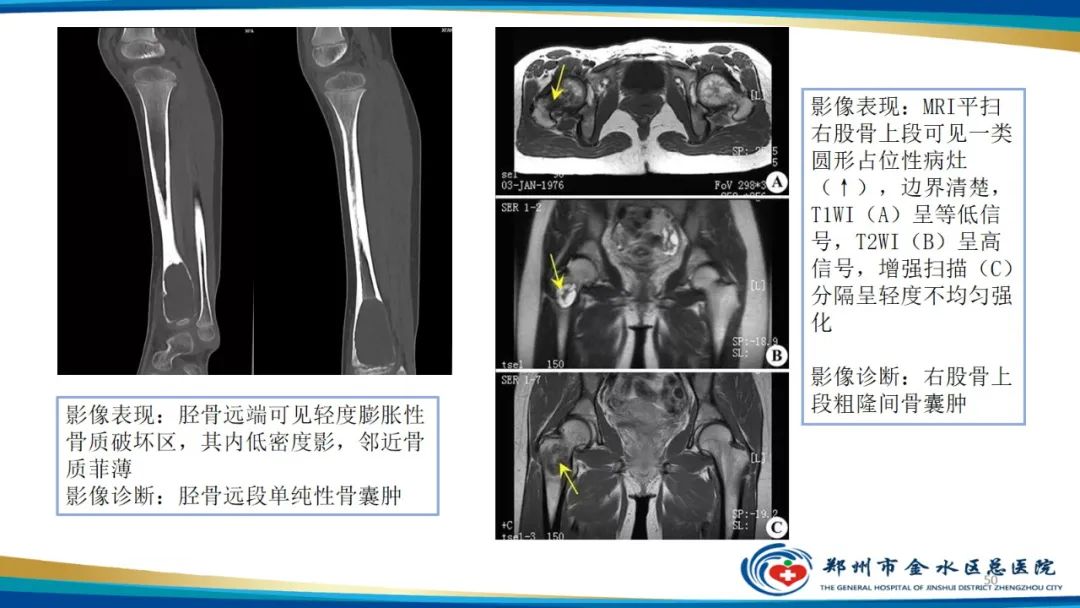 影像PPT - 【PPT】良性骨肿瘤的诊断及鉴别诊断-50