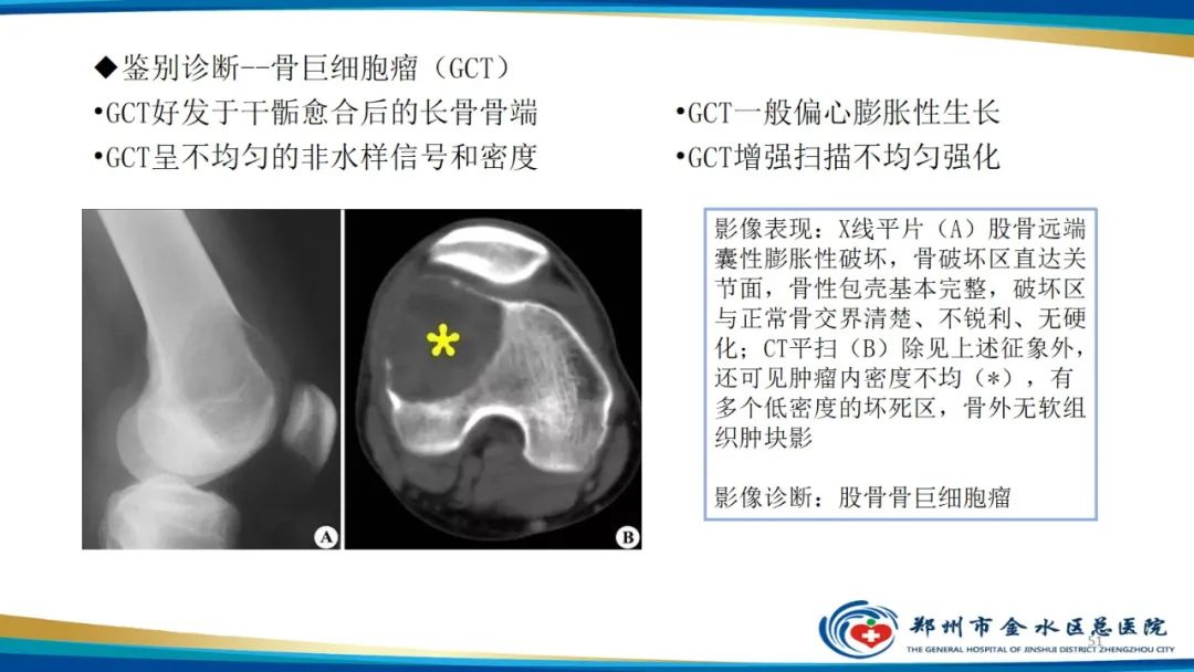 影像PPT - 【PPT】良性骨肿瘤的诊断及鉴别诊断-51