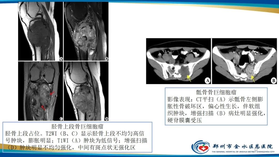 影像PPT - 【PPT】良性骨肿瘤的诊断及鉴别诊断-52