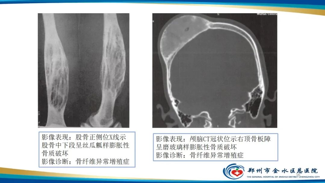 影像PPT - 【PPT】良性骨肿瘤的诊断及鉴别诊断-56