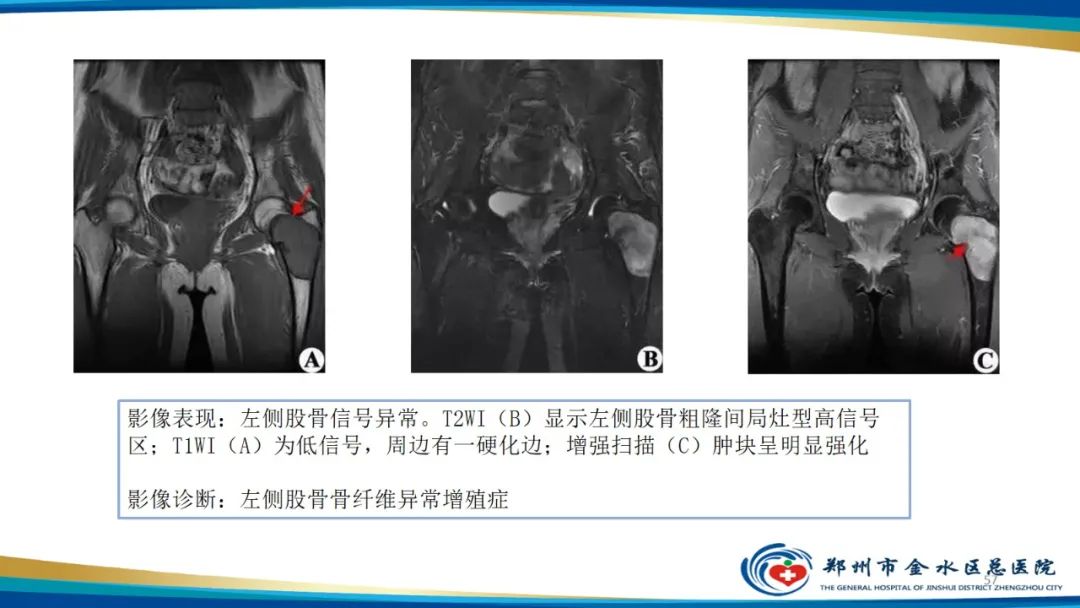 影像PPT - 【PPT】良性骨肿瘤的诊断及鉴别诊断-57
