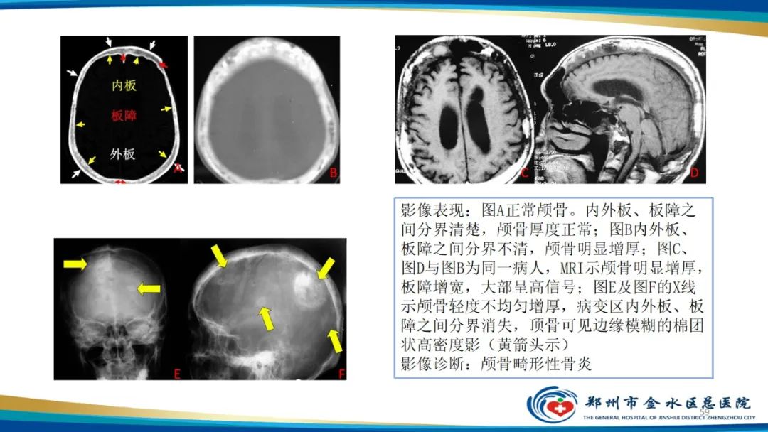 影像PPT - 【PPT】良性骨肿瘤的诊断及鉴别诊断-59