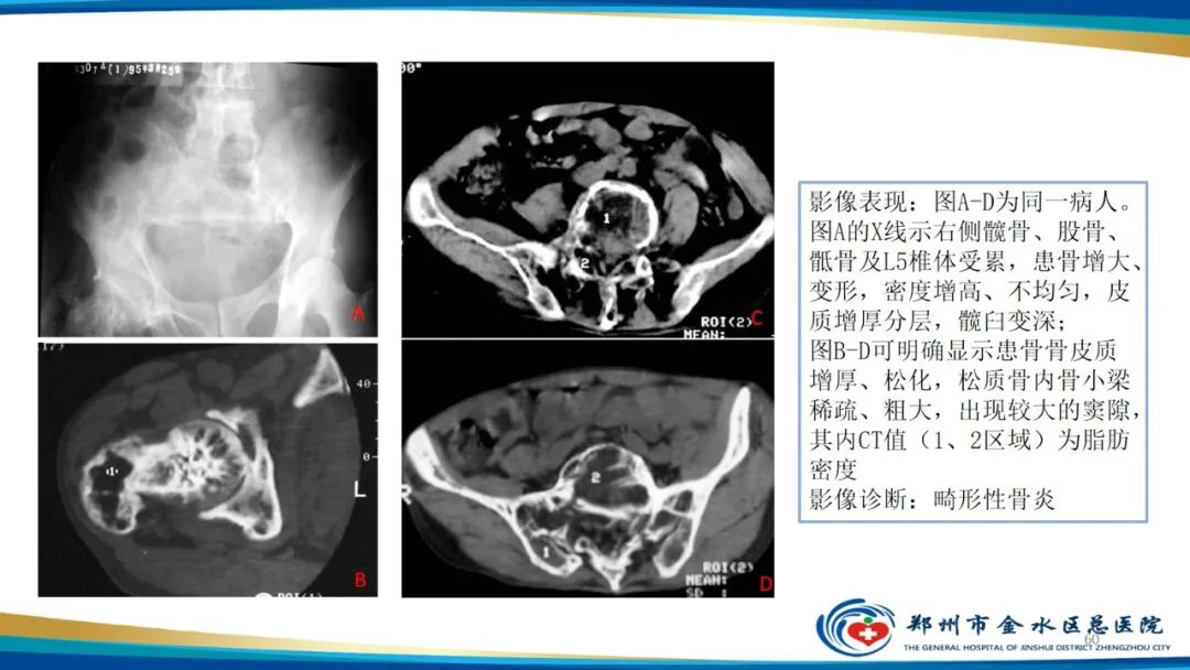 影像PPT - 【PPT】良性骨肿瘤的诊断及鉴别诊断-60