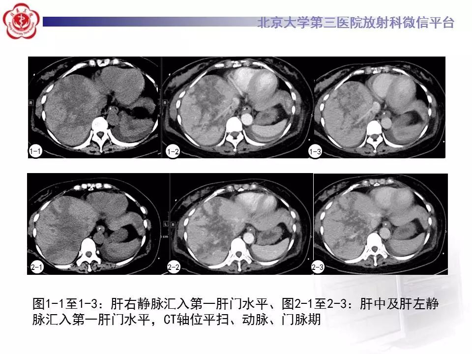 影像PPT - 【PPT】HELLP综合征肝脏影像学表现-6