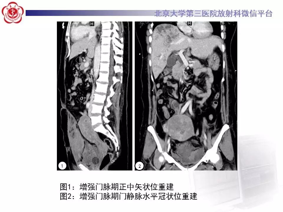 影像PPT - 【PPT】HELLP综合征肝脏影像学表现-9