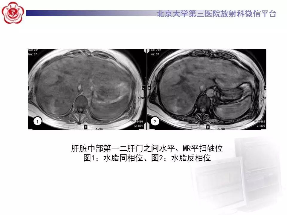 影像PPT - 【PPT】HELLP综合征肝脏影像学表现-11