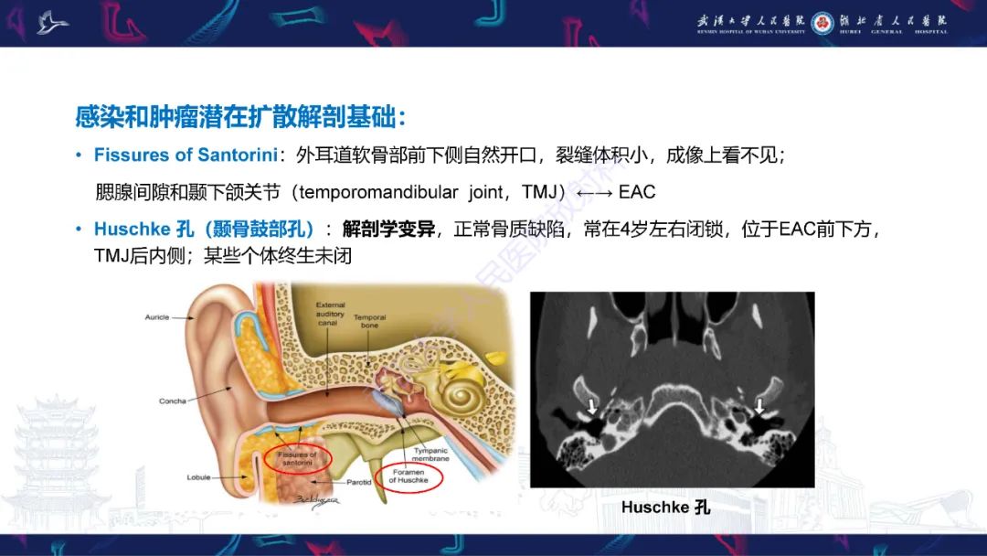 影像PPT - 【PPT】外耳道胆脂瘤影像诊断-5