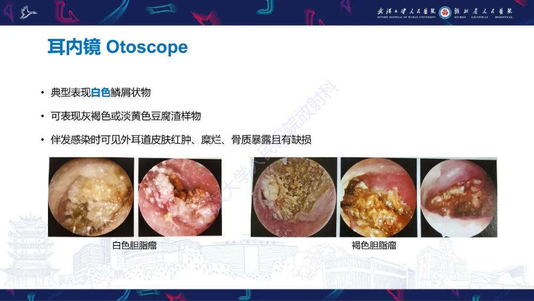 影像PPT - 【PPT】外耳道胆脂瘤影像诊断-9