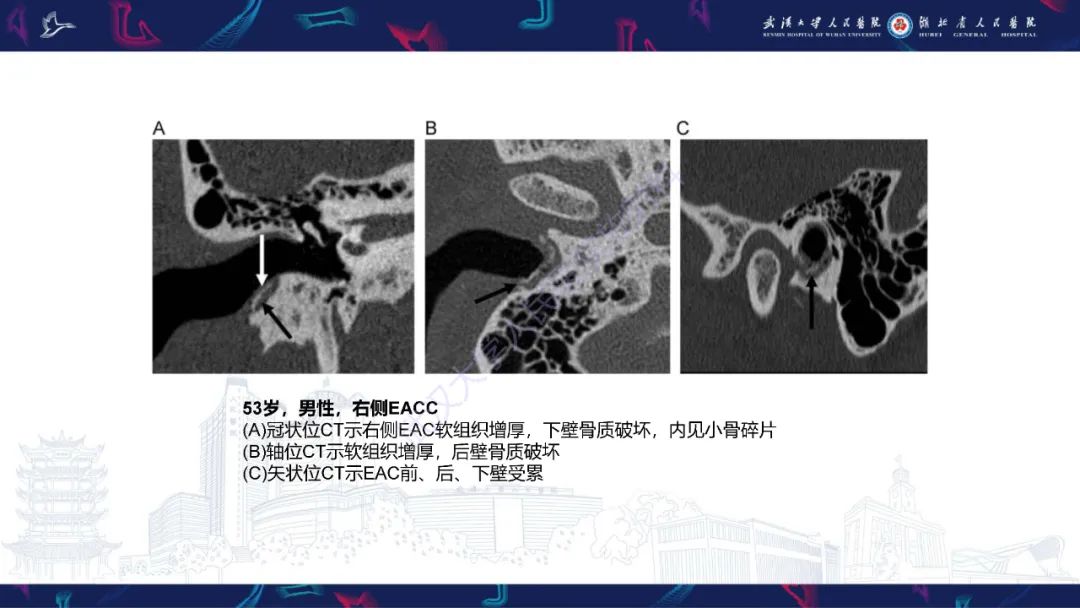 影像PPT - 【PPT】外耳道胆脂瘤影像诊断-13