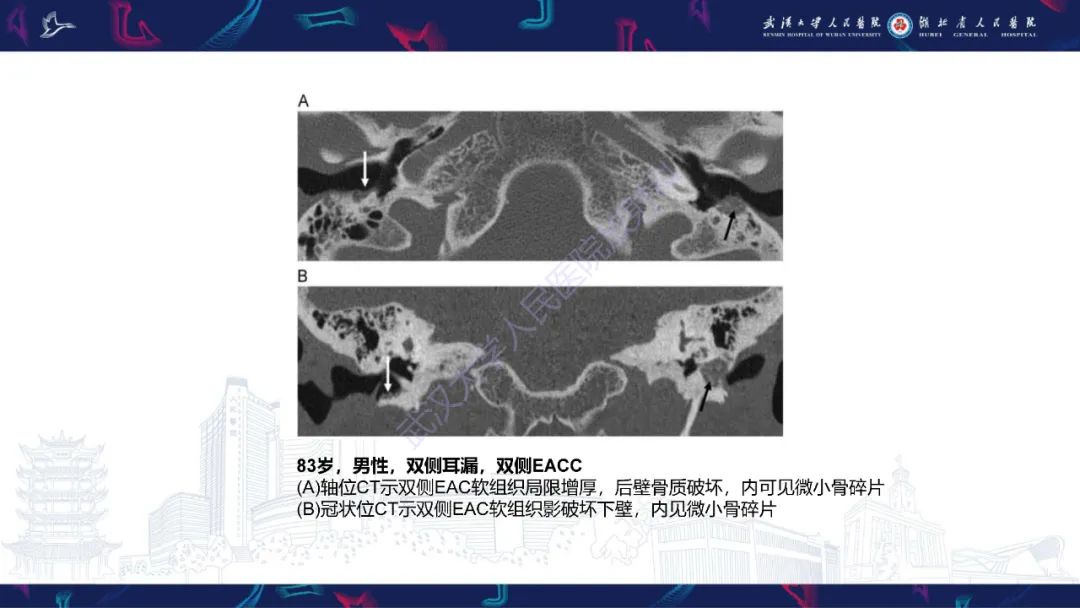 影像PPT - 【PPT】外耳道胆脂瘤影像诊断-14
