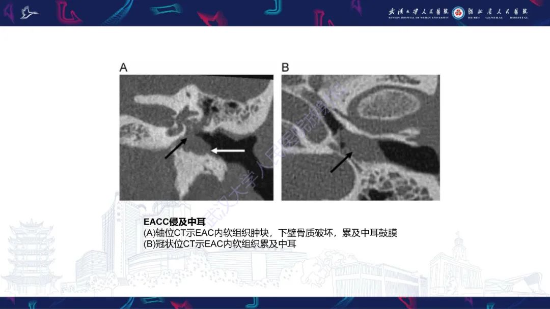影像PPT - 【PPT】外耳道胆脂瘤影像诊断-15