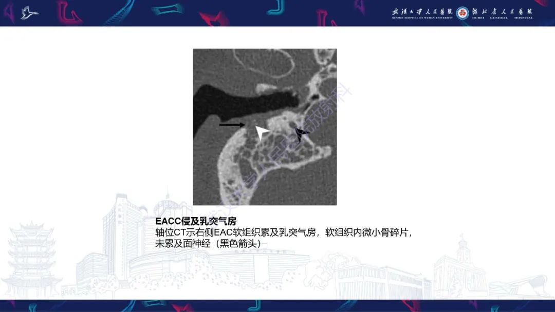 影像PPT - 【PPT】外耳道胆脂瘤影像诊断-16