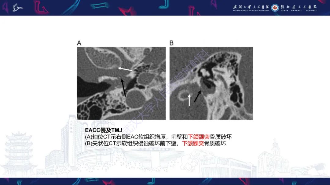 影像PPT - 【PPT】外耳道胆脂瘤影像诊断-18