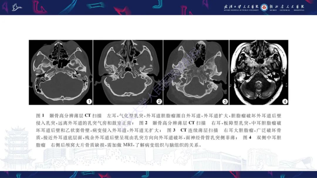 影像PPT - 【PPT】外耳道胆脂瘤影像诊断-22
