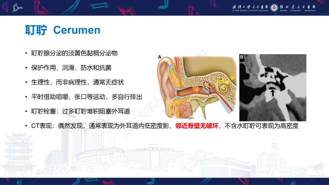 影像PPT - 【PPT】外耳道胆脂瘤影像诊断-23