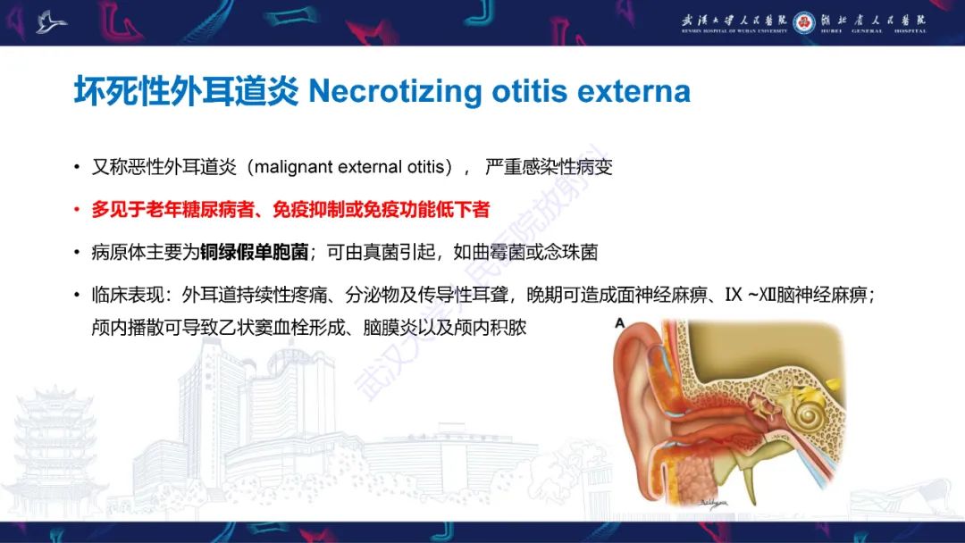 影像PPT - 【PPT】外耳道胆脂瘤影像诊断-24