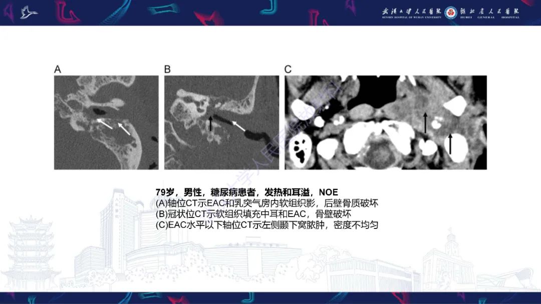 影像PPT - 【PPT】外耳道胆脂瘤影像诊断-26