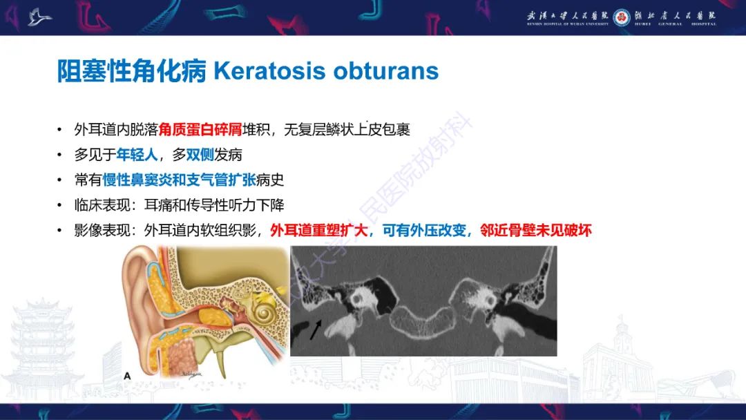 影像PPT - 【PPT】外耳道胆脂瘤影像诊断-28