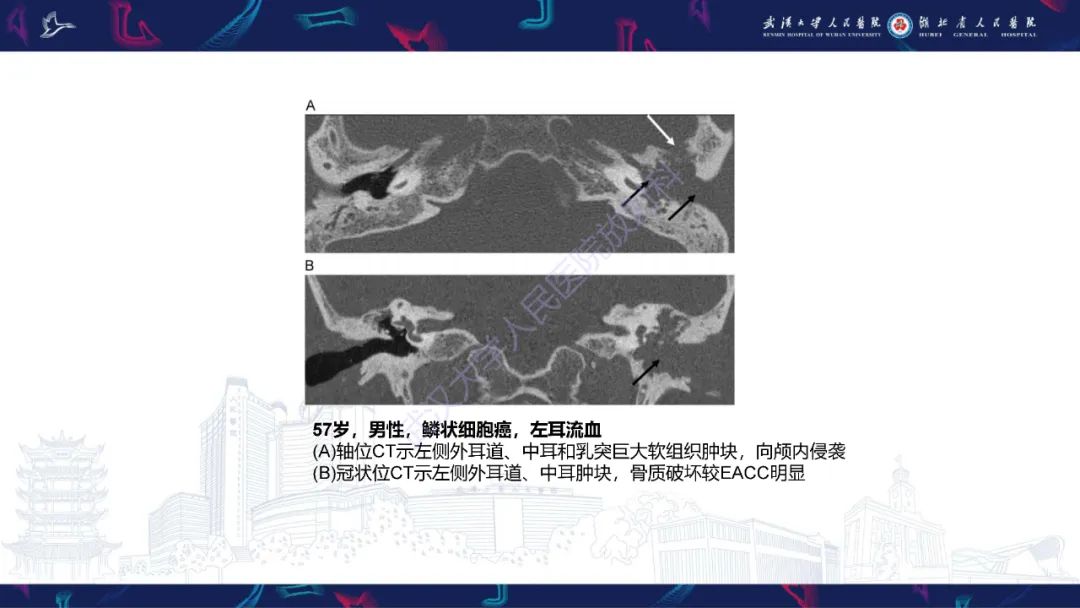 影像PPT - 【PPT】外耳道胆脂瘤影像诊断-30