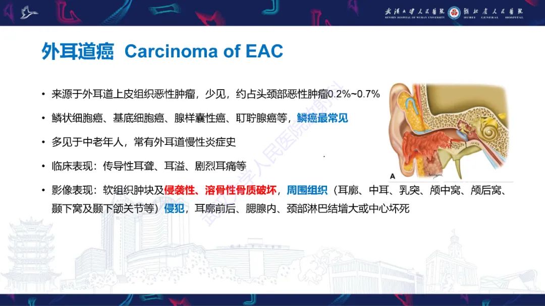 影像PPT - 【PPT】外耳道胆脂瘤影像诊断-29