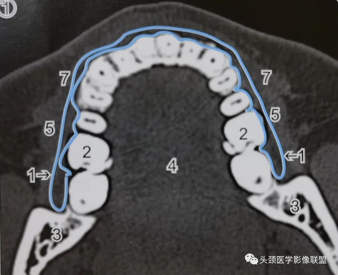 影像PPT - 口腔前庭影像解剖-1