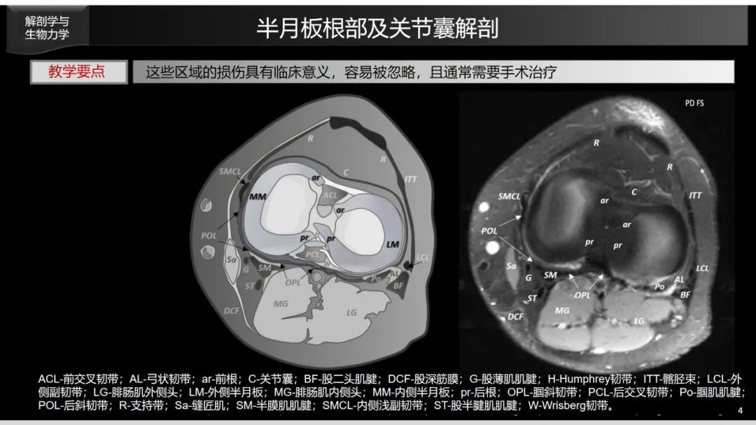 影像PPT - 【PPT】半月板根部,Ramp区,修复,及其后遗症-8 影像PPT - 【PPT】半月板根部,Ramp区,修复,及其后遗症-8