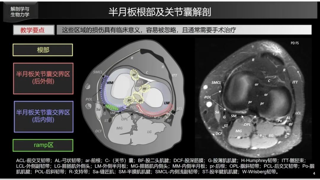 影像PPT - 【PPT】半月板根部,Ramp区,修复,及其后遗症-10 影像PPT - 【PPT】半月板根部,Ramp区,修复,及其后遗症-10