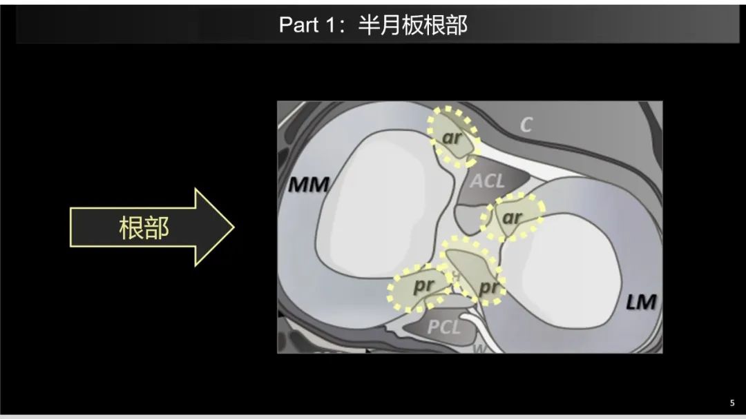 影像PPT - 【PPT】半月板根部,Ramp区,修复,及其后遗症-12 影像PPT - 【PPT】半月板根部,Ramp区,修复,及其后遗症-12