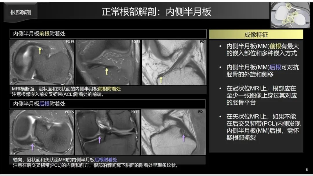 影像PPT - 【PPT】半月板根部,Ramp区,修复,及其后遗症-14 影像PPT - 【PPT】半月板根部,Ramp区,修复,及其后遗症-14
