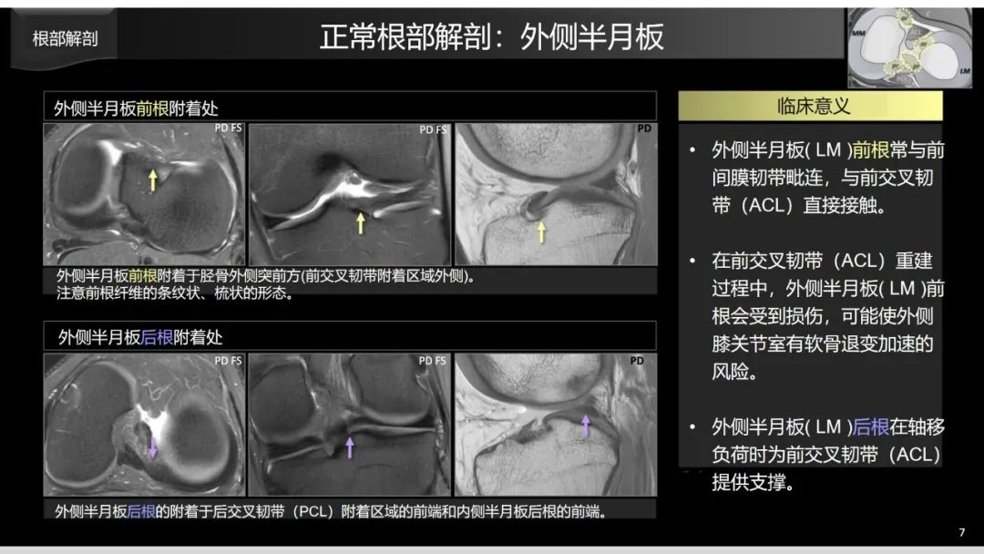 影像PPT - 【PPT】半月板根部,Ramp区,修复,及其后遗症-16 影像PPT - 【PPT】半月板根部,Ramp区,修复,及其后遗症-16