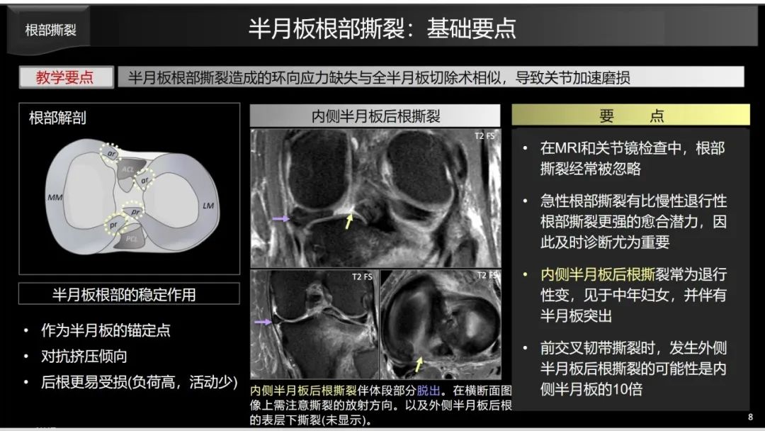 影像PPT - 【PPT】半月板根部,Ramp区,修复,及其后遗症-18 影像PPT - 【PPT】半月板根部,Ramp区,修复,及其后遗症-18