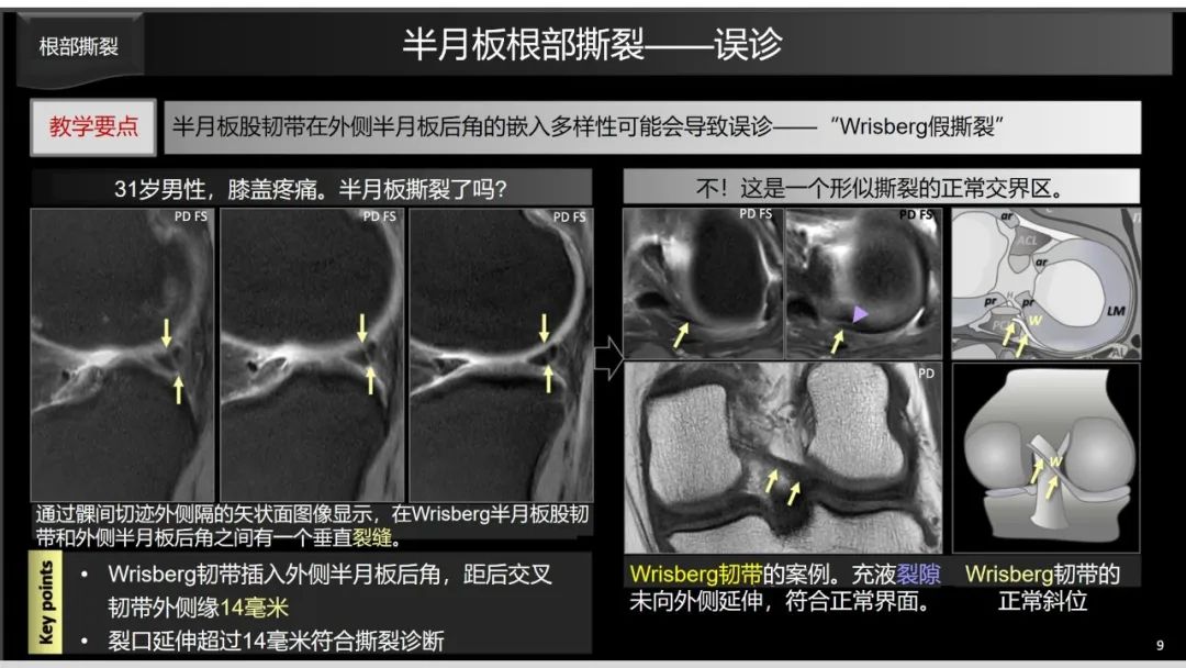 影像PPT - 【PPT】半月板根部,Ramp区,修复,及其后遗症-19 影像PPT - 【PPT】半月板根部,Ramp区,修复,及其后遗症-19