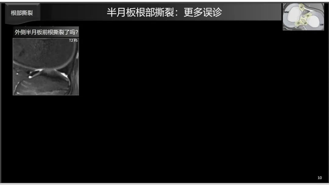 影像PPT - 【PPT】半月板根部,Ramp区,修复,及其后遗症-22 影像PPT - 【PPT】半月板根部,Ramp区,修复,及其后遗症-22