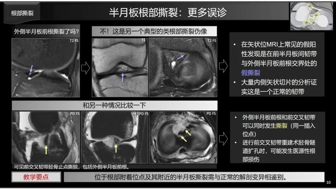 影像PPT - 【PPT】半月板根部,Ramp区,修复,及其后遗症-24 影像PPT - 【PPT】半月板根部,Ramp区,修复,及其后遗症-24