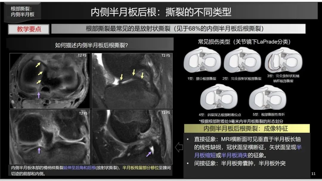 影像PPT - 【PPT】半月板根部,Ramp区,修复,及其后遗症-26 影像PPT - 【PPT】半月板根部,Ramp区,修复,及其后遗症-26