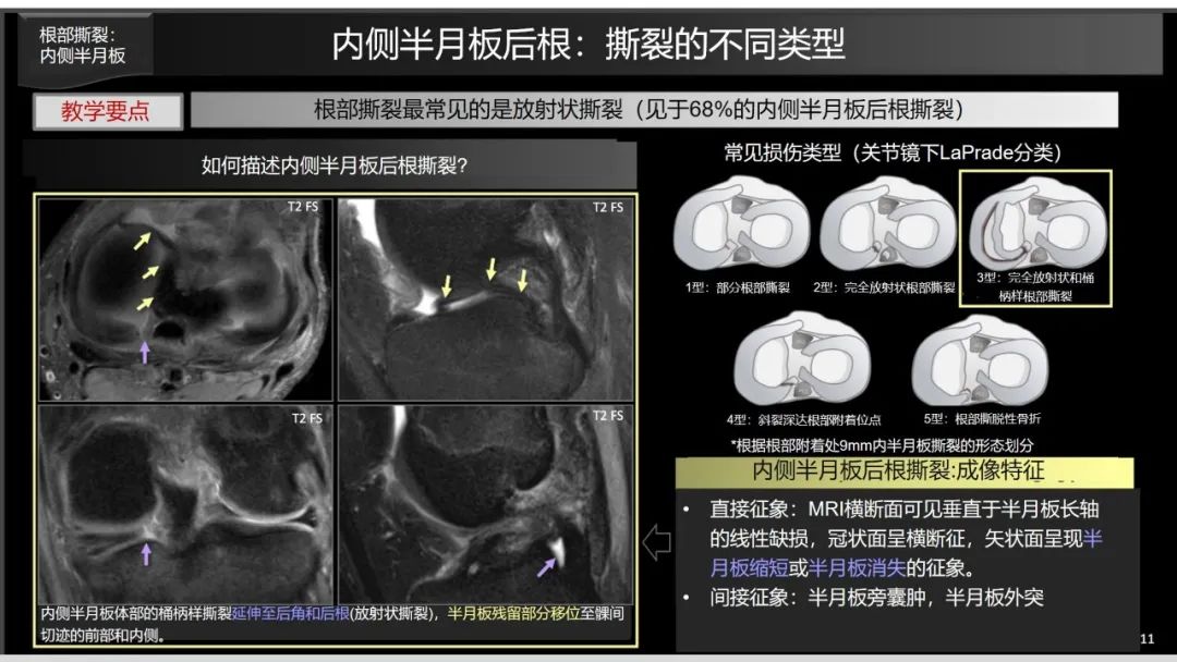 影像PPT - 【PPT】半月板根部,Ramp区,修复,及其后遗症-28 影像PPT - 【PPT】半月板根部,Ramp区,修复,及其后遗症-28