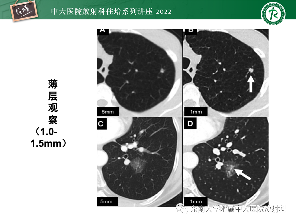 影像PPT - 【PPT】 肺Lung-RADS（V1.1）解读及临床应用要点-11