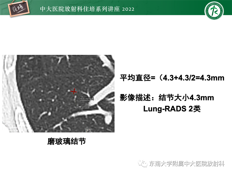 影像PPT - 【PPT】 肺Lung-RADS（V1.1）解读及临床应用要点-15