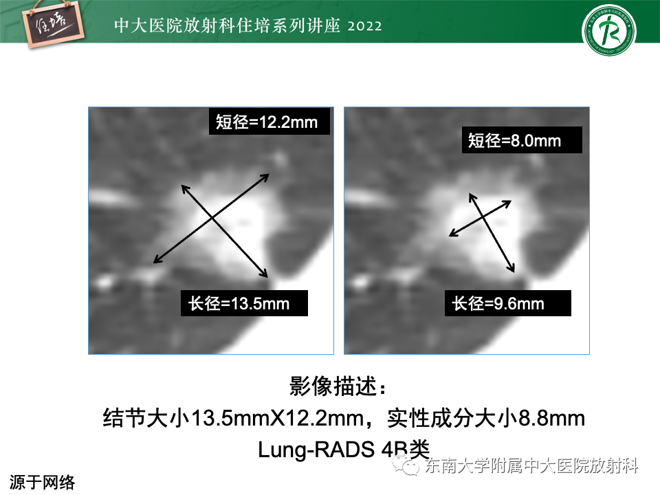 影像PPT - 【PPT】 肺Lung-RADS（V1.1）解读及临床应用要点-16