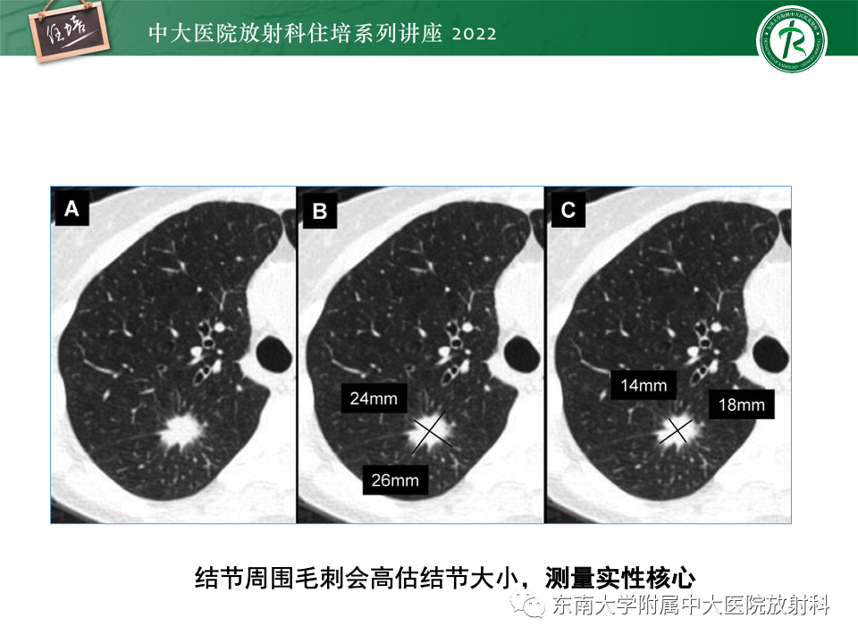 影像PPT - 【PPT】 肺Lung-RADS（V1.1）解读及临床应用要点-18