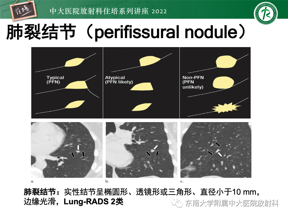 影像PPT - 【PPT】 肺Lung-RADS（V1.1）解读及临床应用要点-28