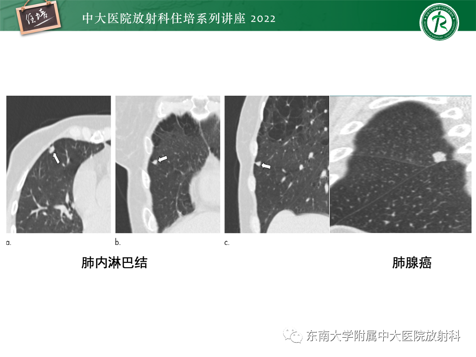 影像PPT - 【PPT】 肺Lung-RADS（V1.1）解读及临床应用要点-29