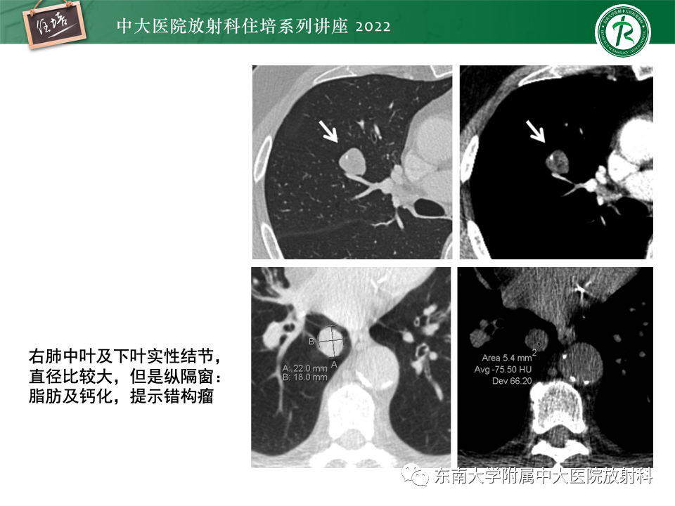 影像PPT - 【PPT】 肺Lung-RADS（V1.1）解读及临床应用要点-24