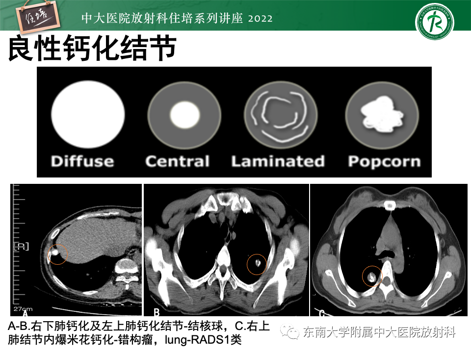 影像PPT - 【PPT】 肺Lung-RADS（V1.1）解读及临床应用要点-23
