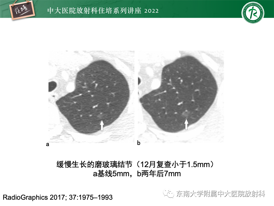 影像PPT - 【PPT】 肺Lung-RADS（V1.1）解读及临床应用要点-30