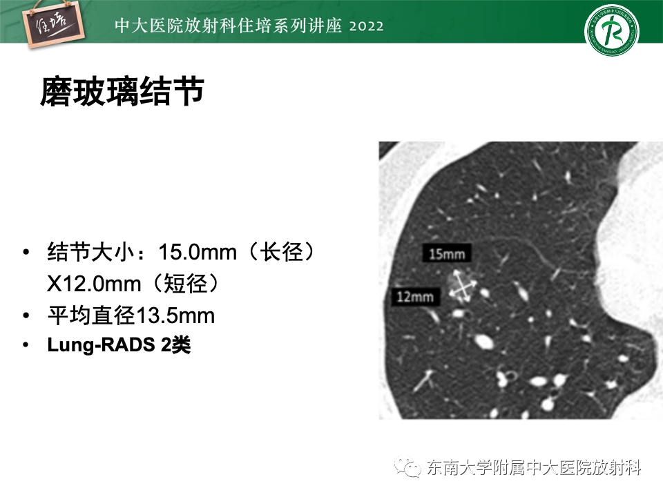 影像PPT - 【PPT】 肺Lung-RADS（V1.1）解读及临床应用要点-27