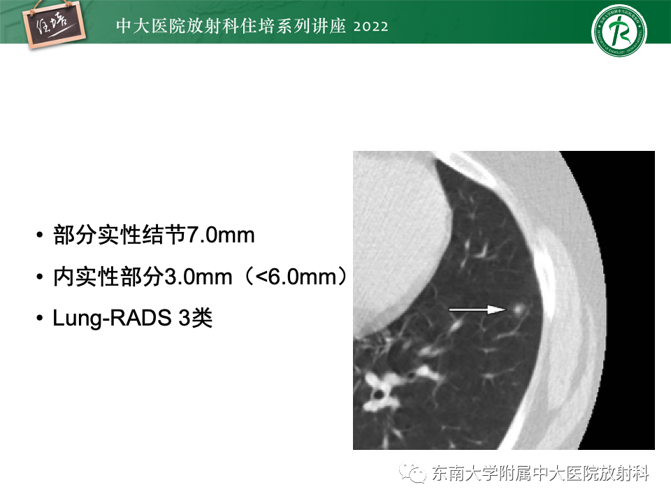 影像PPT - 【PPT】 肺Lung-RADS（V1.1）解读及临床应用要点-35