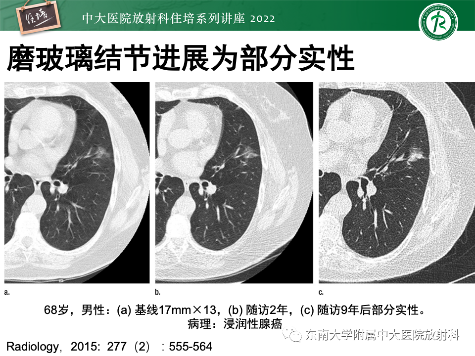 影像PPT - 【PPT】 肺Lung-RADS（V1.1）解读及临床应用要点-31