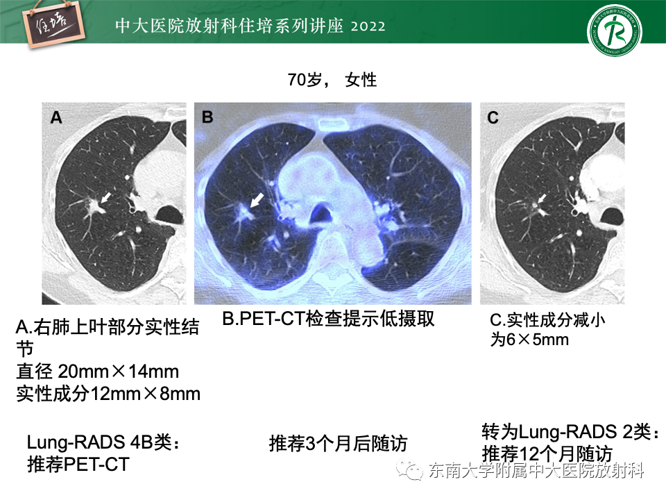 影像PPT - 【PPT】 肺Lung-RADS（V1.1）解读及临床应用要点-44