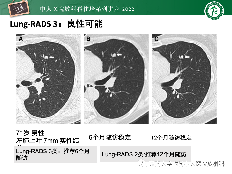 影像PPT - 【PPT】 肺Lung-RADS（V1.1）解读及临床应用要点-34